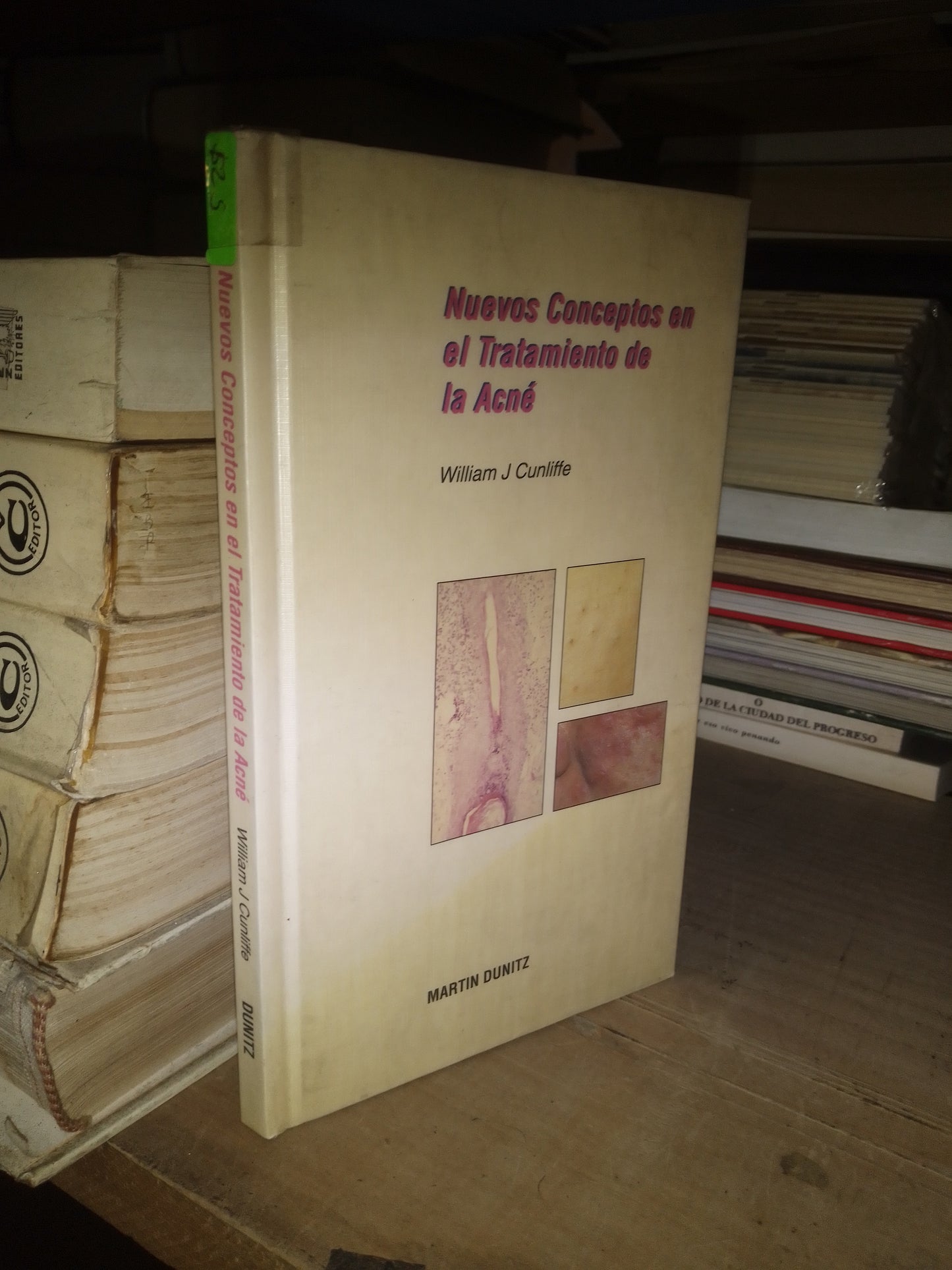 NUEVOS CONCEPTOS EN EL TRATAMIENTO DE LA ACNÉ POR WILLIAM J. CUNLIFFE USADO MEDICINA LITERARIO 207