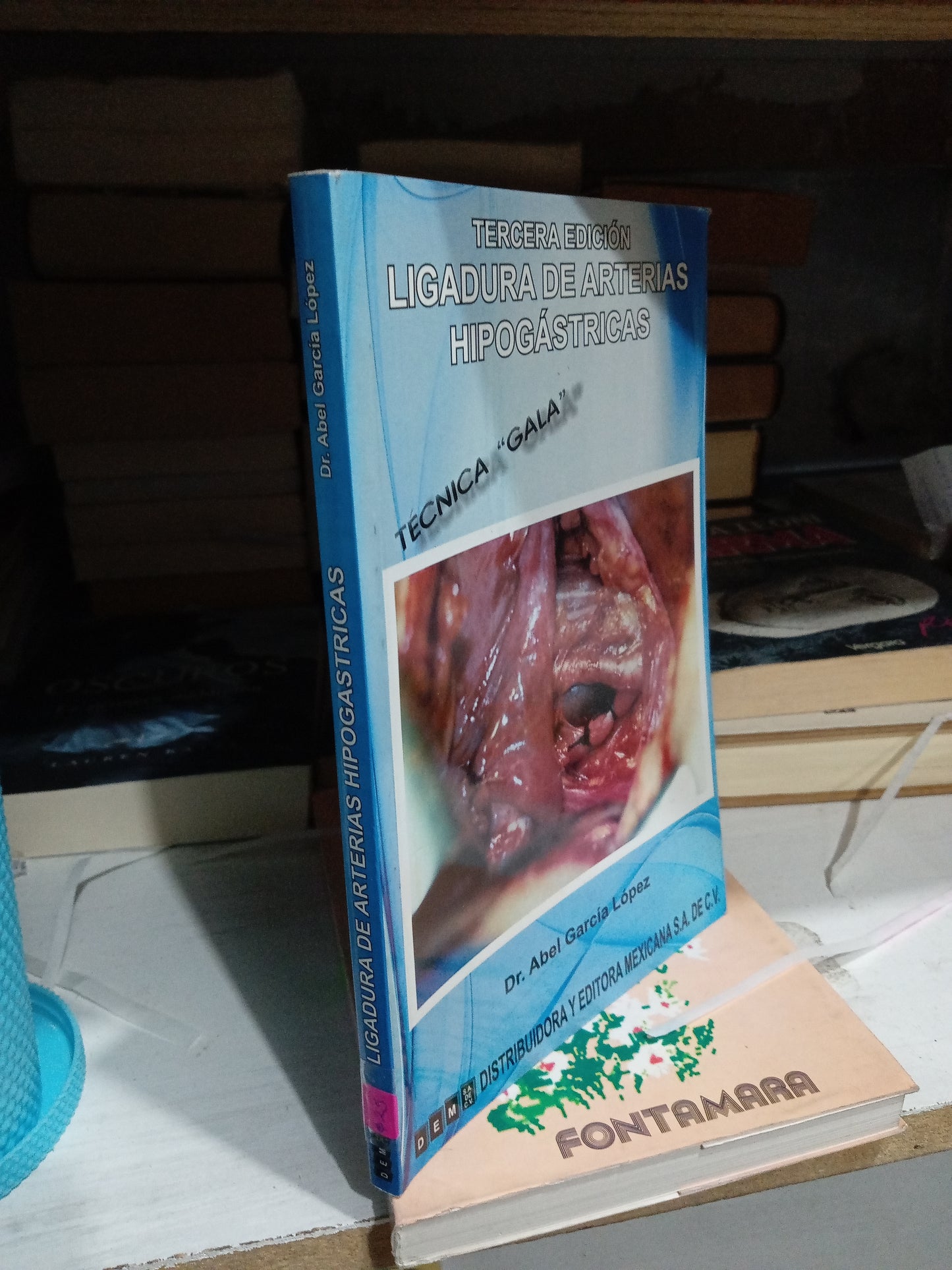 LIGADURA DE ARTERIAS HIPOGASTRICAS POR DR ABEL GARCIA LOPEZ USADO SALUD JUAREZ